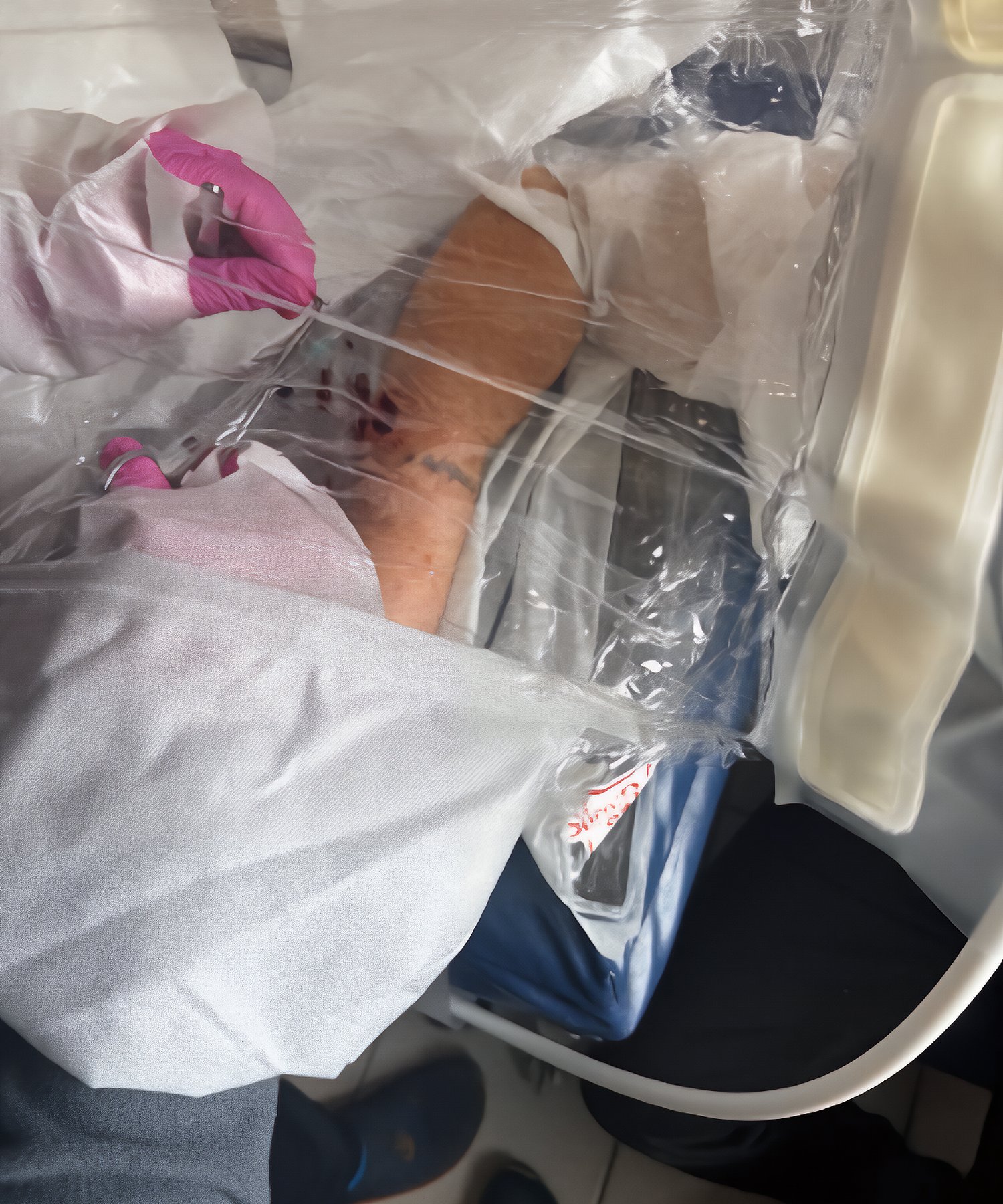 Forearm Wound Debridement & Closure
